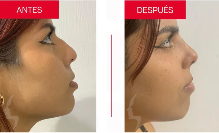 Rinoplastia en Tampico, caso 1: perfil de la nariz antes y después de la cirugía con el Dr. Sergio Turrubiates