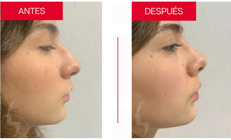 Rinoplastia en Tampico, caso 2: perfil de la nariz antes y después de la cirugía con el Dr. Sergio Turrubiates