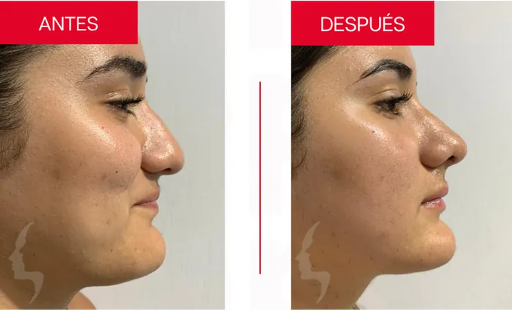 Rinoplastia en Tampico, caso 3: perfil de la nariz antes y después de la cirugía con el Dr. Sergio Turrubiates