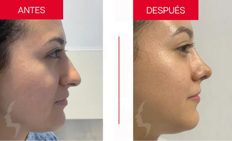 Rinoplastia en Tampico, caso 4: perfil de la nariz antes y después de la cirugía con el Dr. Sergio Turrubiates