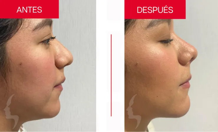 Rinoplastia en Tampico, caso 5: perfil de la nariz antes y después de la cirugía con el Dr. Sergio Turrubiates
