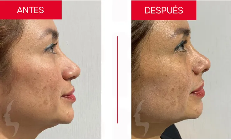 Rinoplastia en Tampico, caso 6: perfil de la nariz antes y después de la cirugía con el Dr. Sergio Turrubiates