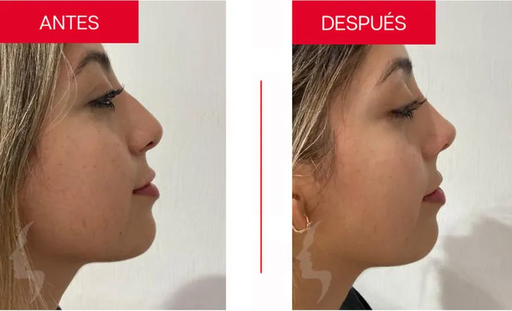 Rinoplastia en Tampico, caso 7: perfil de la nariz antes y después de la cirugía con el Dr. Sergio Turrubiates