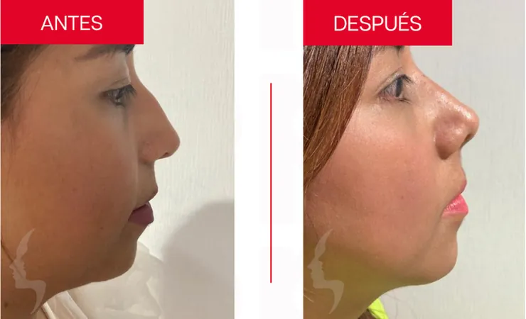 Rinoplastia en Tampico, caso 8: perfil de la nariz antes y después de la cirugía con el Dr. Sergio Turrubiates