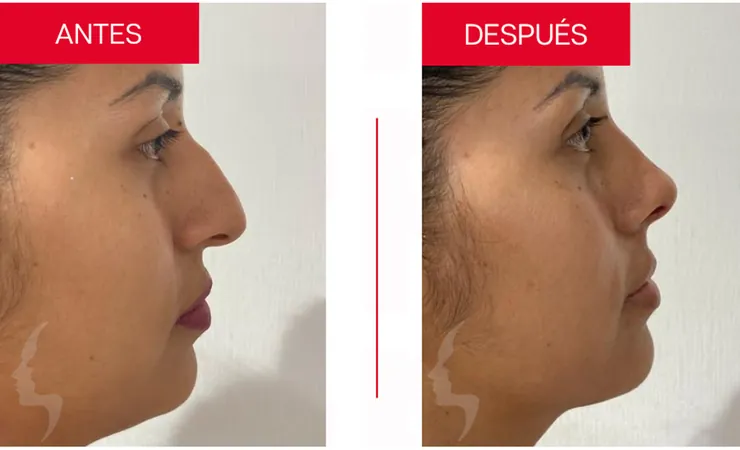 Rinoplastia en Tampico, caso 9: perfil de la nariz antes y después de la cirugía con el Dr. Sergio Turrubiates