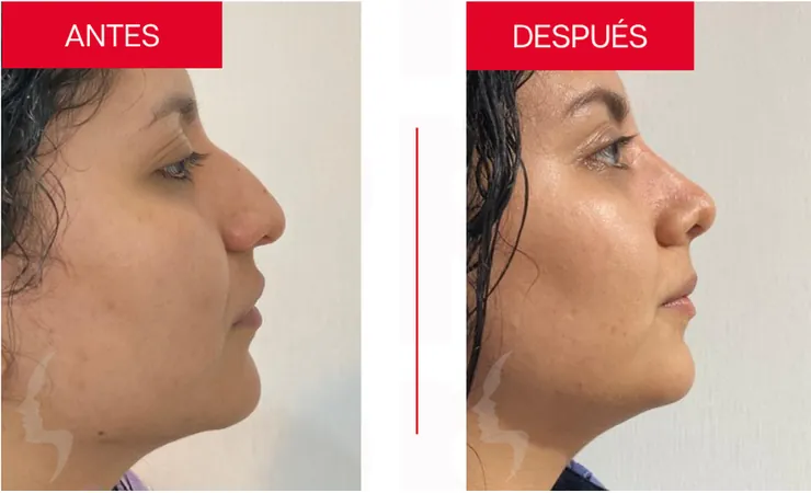 Rinoplastia en Tampico, caso 10: perfil de la nariz antes y después de la cirugía con el Dr. Sergio Turrubiates