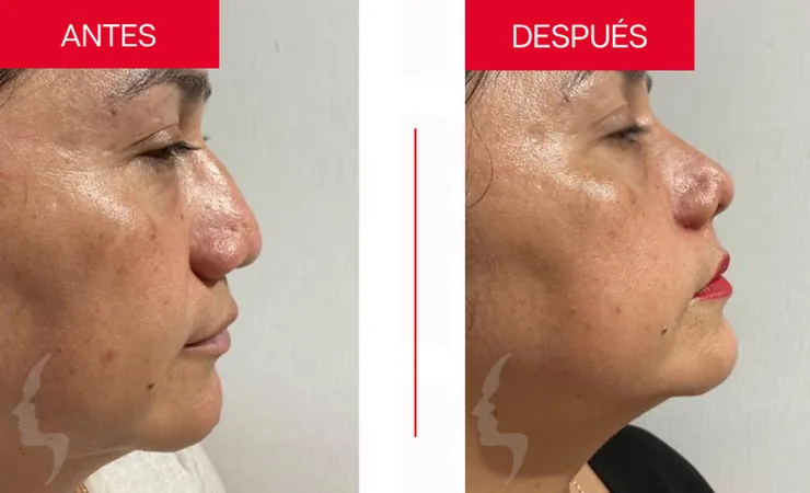 Rinoplastia en Tampico, caso 11: perfil de la nariz antes y después de la cirugía con el Dr. Sergio Turrubiates