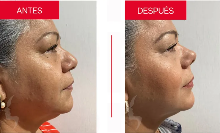 Rinoplastia en Tampico, caso 12: perfil de la nariz antes y después de la cirugía con el Dr. Sergio Turrubiates