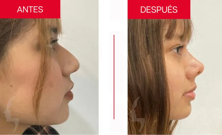Rinoplastia en Tampico, caso 13: perfil de la nariz antes y después de la cirugía con el Dr. Sergio Turrubiates