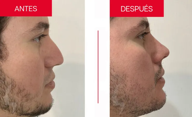 Rinoplastia en Tampico, caso 14: perfil de la nariz antes y después de la cirugía con el Dr. Sergio Turrubiates