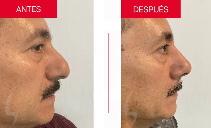 Rinoplastia en Tampico, caso 15: perfil de la nariz antes y después de la cirugía con el Dr. Sergio Turrubiates