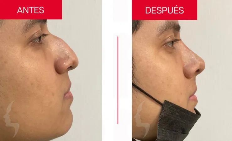 Rinoplastia en Tampico, caso 16: perfil de la nariz antes y después de la cirugía con el Dr. Sergio Turrubiates