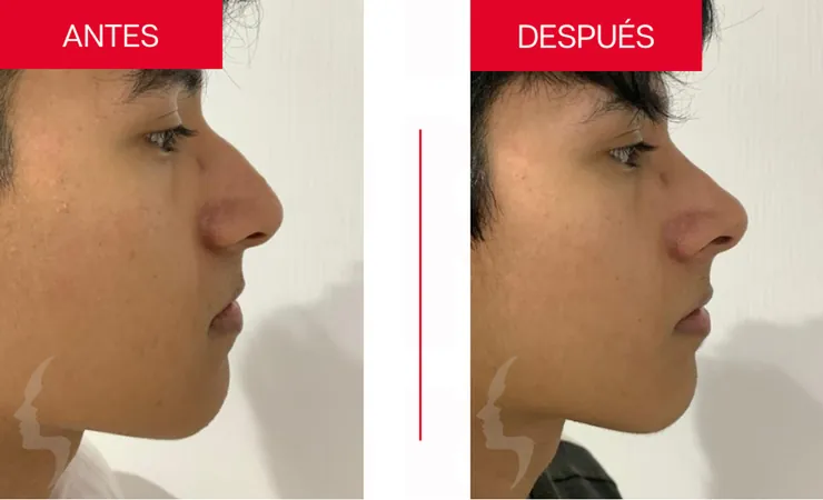 Rinoplastia en Tampico, caso 17: perfil de la nariz antes y después de la cirugía con el Dr. Sergio Turrubiates