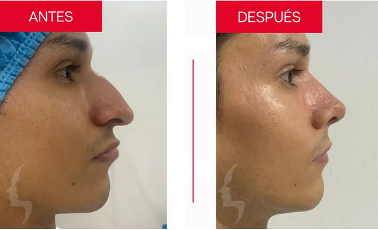 Rinoplastia en Tampico, caso 18: perfil de la nariz antes y después de la cirugía con el Dr. Sergio Turrubiates