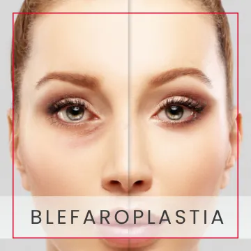 Blefaroplastia